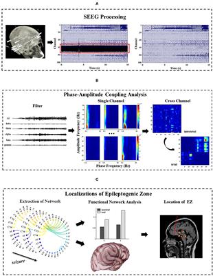 Epileptogenic Zone Location of Temporal Lobe Epilepsy by Cross-Frequency Coupling Analysis